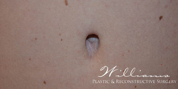 Belly Button Surgery Before & After Photos - Dalton & Chattanooga