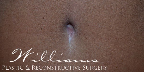 Belly Button Surgery Before & After Photos - Dalton & Chattanooga